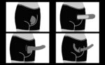 Ingen Cueca Boxer para Fixação de Packer - Imagem 19